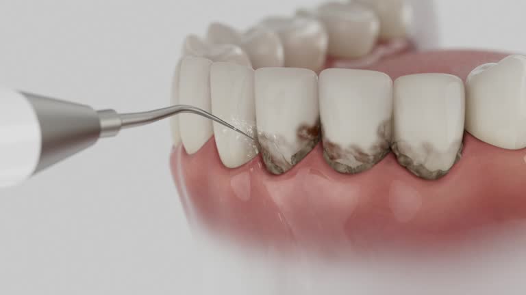 Trusted Wisdom Tooth Removal service in Southport, NC - Dentist Open Now